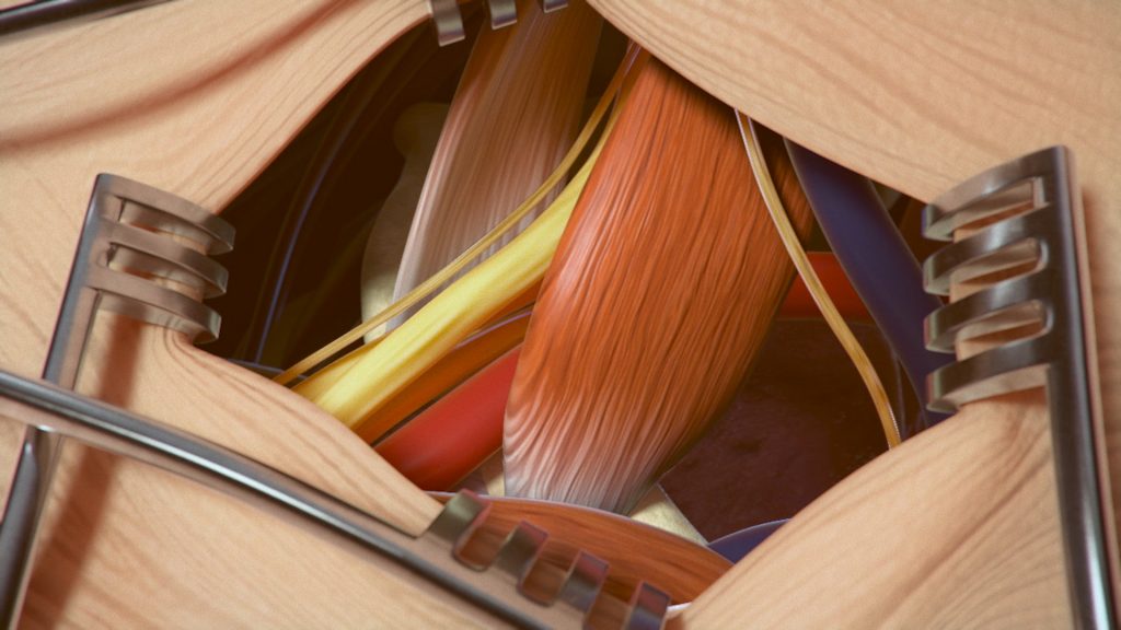 A precise illustration of a surgical procedure showing the inside of a patient's body