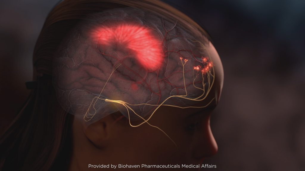 Pain centers of the brain light up during a migraine