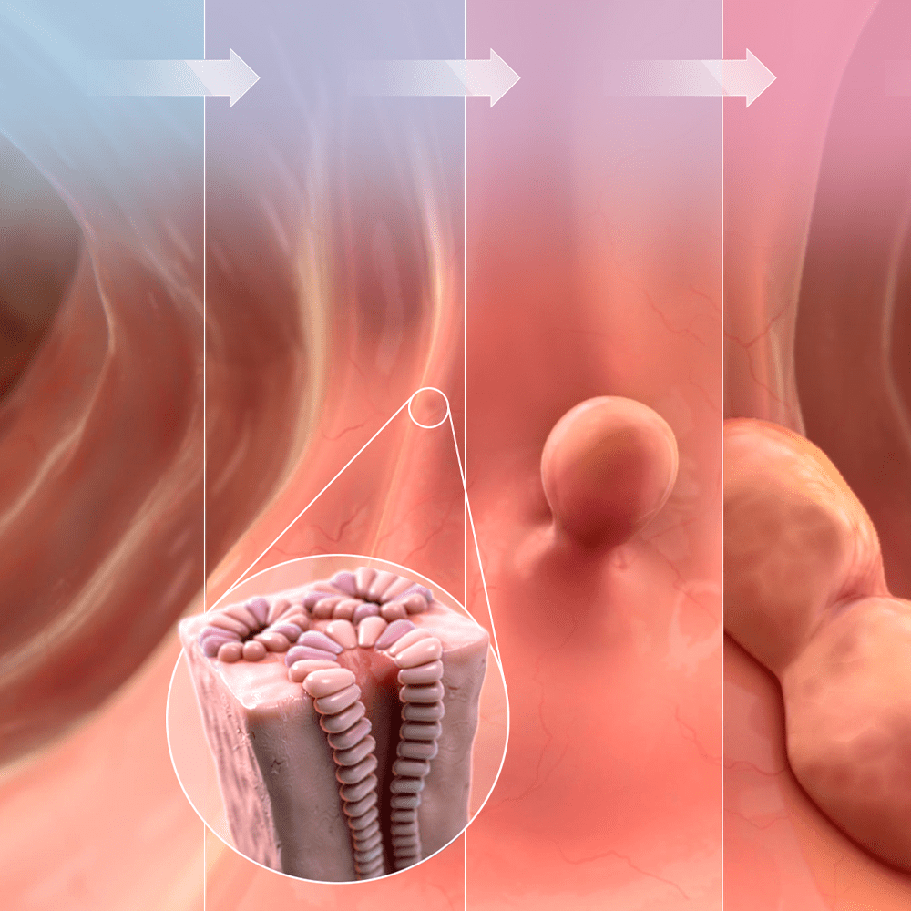 Colorectal Cancer Progression