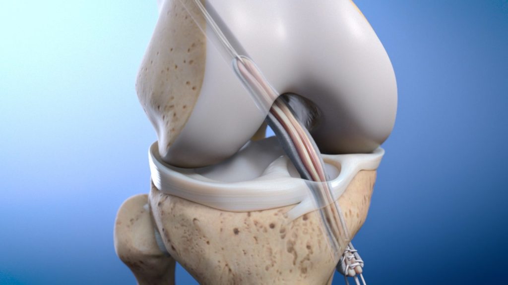 Illustration of a knee joint showcasing the bones, ligaments, and cartilage. The image highlights the structure and connection between the femur, tibia, and fibula on a blue gradient background, offering insight into ligament repair techniques like BioBrace for enhanced joint recovery.
