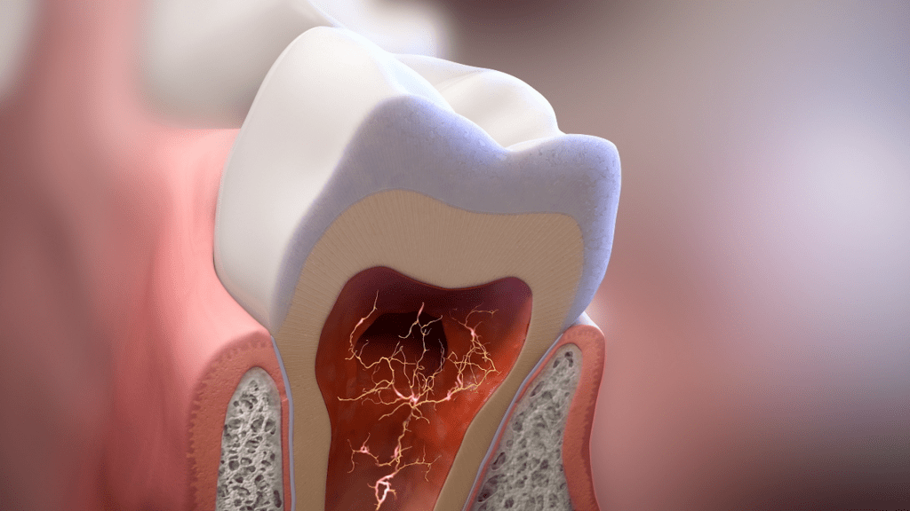 A detailed cutaway view of a tooth reveals its internal structure, including enamel, dentin, and pulp, with lightning-like patterns illustrating nerve sensitivity. Surrounding gum and bone tissue are visible on the sides, offering a professional insight into dental anatomy.