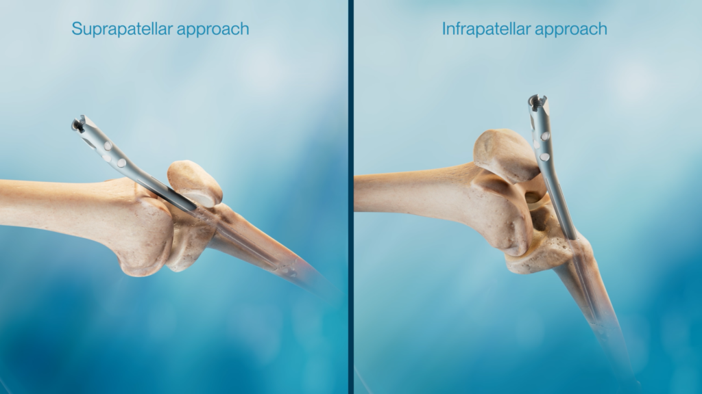 placing the device in the suprapatellar or infrapatellar approach 