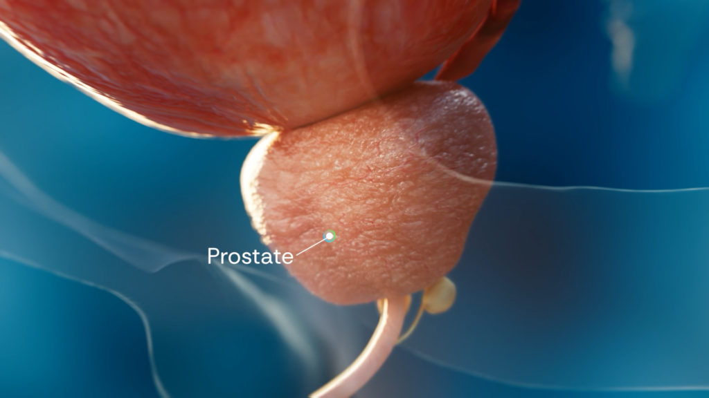 3d model of prostate