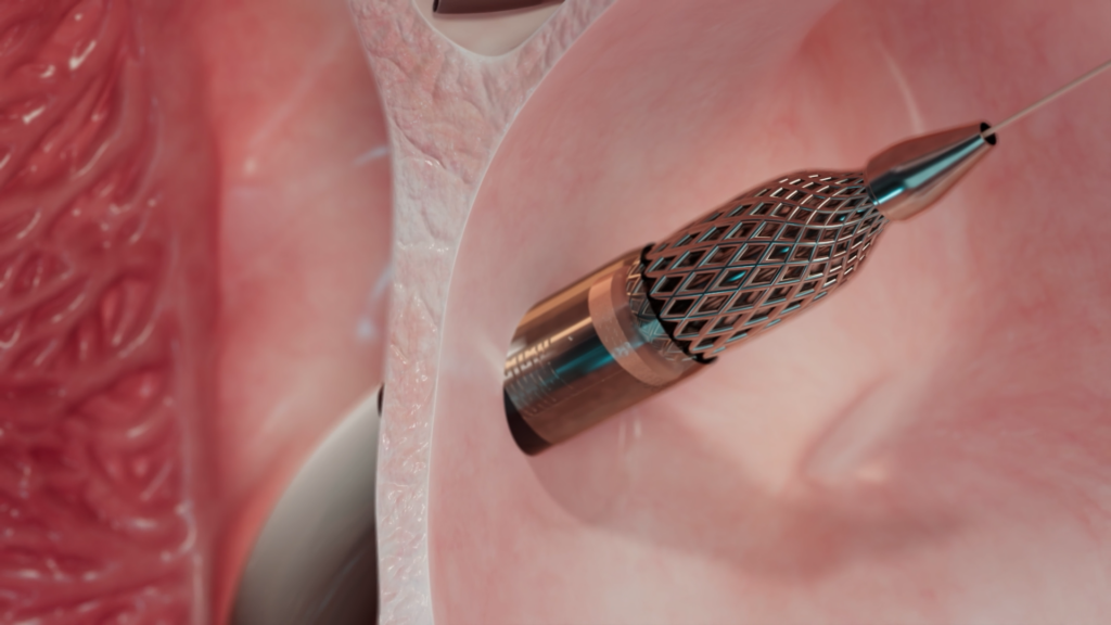 cross section of heart with device
